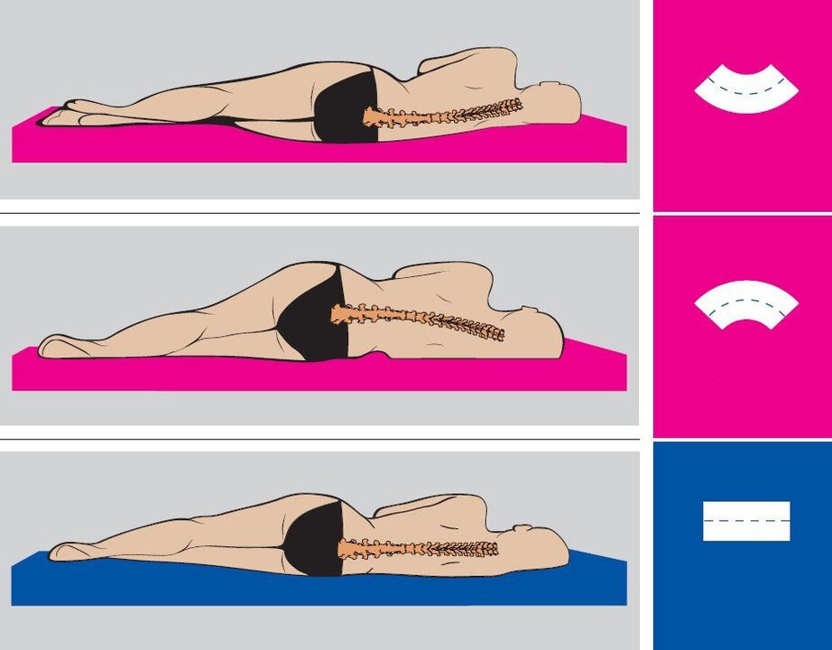 Postura correcta durante el sueño para la osteocondrosis lumbar. 