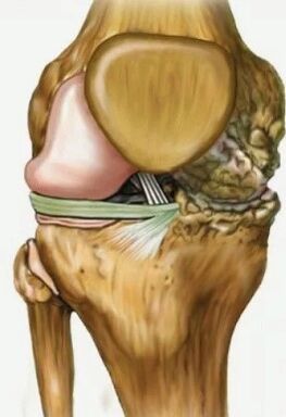 Artrosis de la articulación de la rodilla