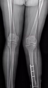 Deformaciones de la rodilla