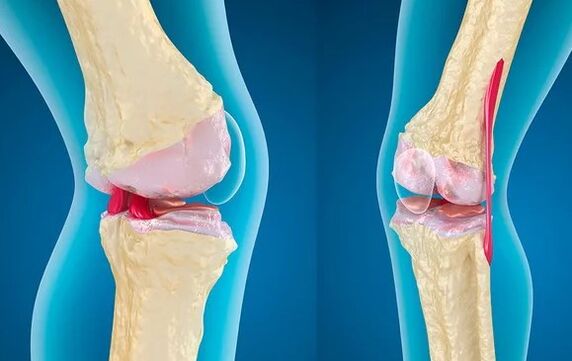 Gonartrosis del tercer grado de la articulación de la rodilla