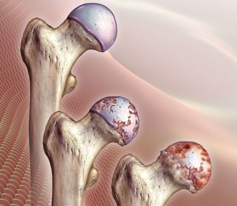 Artrosis de la articulación de la cadera