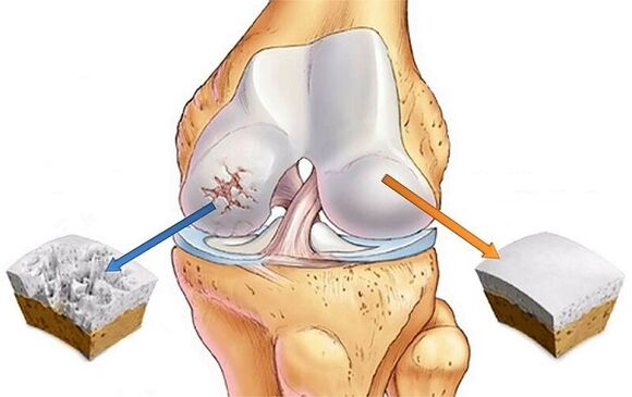 Norma y desviación a la artrosis de la articulación de la rodilla