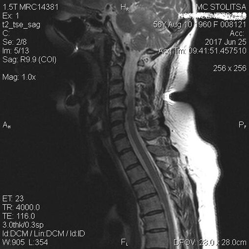 Osteocondrosis y espondilosis de la columna cervical