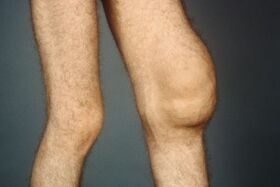 Las causas y síntomas de la osteoartritis de la articulación de la rodilla