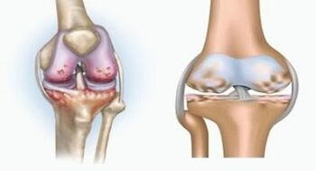 Causas de artritis y artrosis