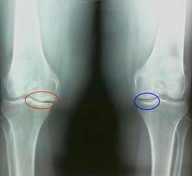 El resultado del tratamiento de la artritis y la artrosis