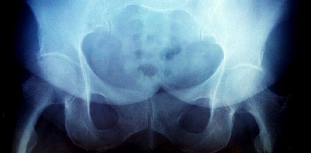 Imagen de rayos x con osteoartritis de segundo grado