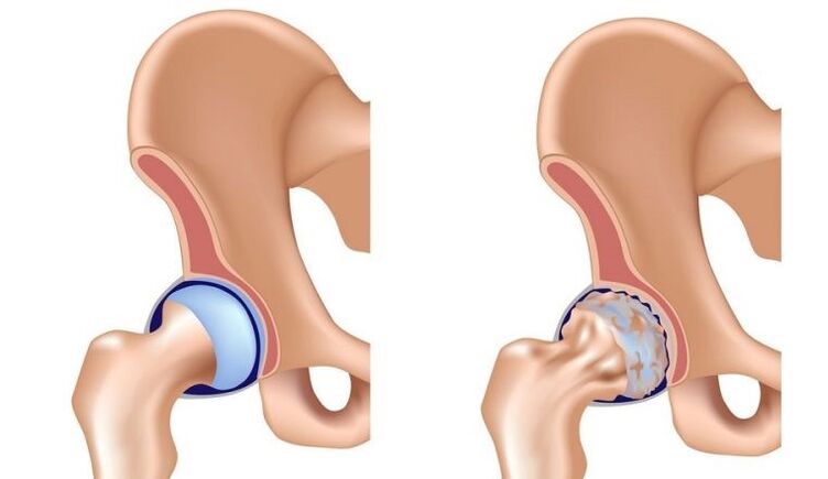 Saludable y junto con la osteoartritis
